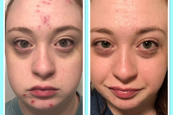 acne-transformation-7