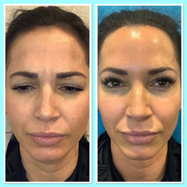 before and after botox in southlake